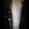 Slishman Traction Splint (STS) - Image 3